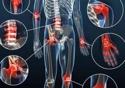 АРТРИТ СИМПТОМИ. ВИДОВЕ АРТРИТ. ЛЕКАРСТВА ЗА АРТРИТ