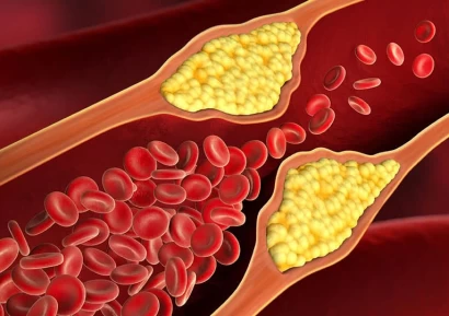 АТЕРОСКЛЕРОЗА - КАКВО ПРЕДСТАВЛЯВА, СИМПТОМИ И ЛЕЧЕНИЕ