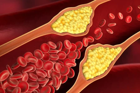 АТЕРОСКЛЕРОЗА - КАКВО ПРЕДСТАВЛЯВА, СИМПТОМИ И ЛЕЧЕНИЕ