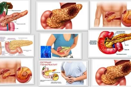 ПЪРВИ СИМПТОМИ НА ПАНКРЕАТИТ. ЛЕЧЕНИЕ НА ПАНКРЕАТИТ. ДИЕТА