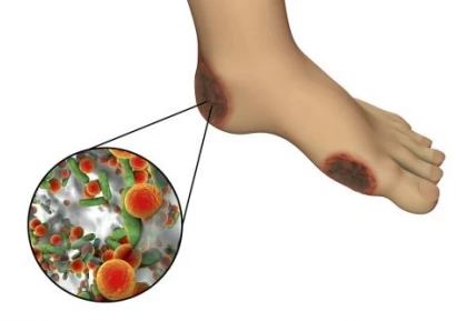 ДИАБЕТНО СТЪПАЛО. СИМПТОМИ, ПРИЧИНИ, ЛЕЧЕНИЕ И ДИЕТА