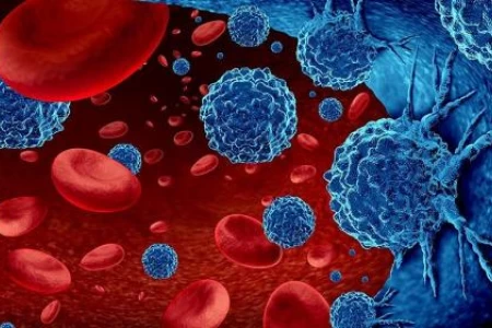 ЛЕВКЕМИЯ СИМПТОМИ. ЛЕВКЕМИЯ ПРИ ДЕЦАТА. ВИДОВЕ И ЛЕЧЕНИЕ