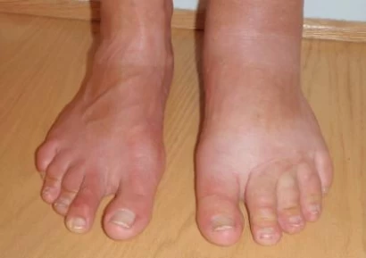 ПОДУВАНЕ НА КРАКАТА. ЯБЪЛКОВ ОЦЕТ ЗА ПОДУТИ КРАКА