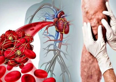 ТРОМБОФЛЕБИТ. ДЪЛБОКА ВЕНОЗНА ТРОМБОЗА. РАЗШИРЕНИ ВЕНИ