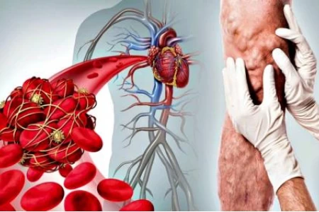 ТРОМБОФЛЕБИТ. ДЪЛБОКА ВЕНОЗНА ТРОМБОЗА. РАЗШИРЕНИ ВЕНИ