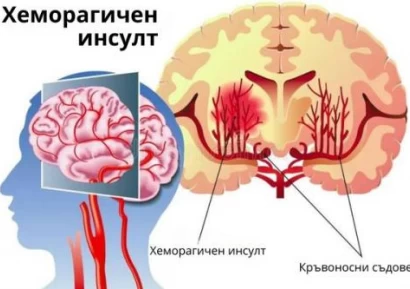 ХЕМОРАГИЧЕН ИНСУЛТ. КРИТИЧНИ ДНИ, ПЪРВА ПОМОЩ И ЛЕЧЕНИЕ