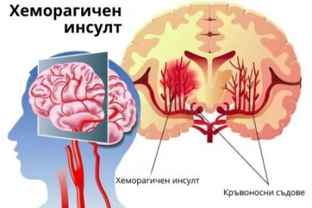 ХЕМОРАГИЧЕН ИНСУЛТ. КРИТИЧНИ ДНИ, ПЪРВА ПОМОЩ И ЛЕЧЕНИЕ