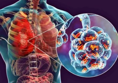ПНЕВМОНИЯ. СИМПТОМИ НА ПНЕВМОНИИ. ВИДОВЕ И ЛЕЧЕНИЕ