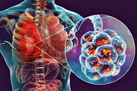 ПНЕВМОНИЯ. СИМПТОМИ НА ПНЕВМОНИИ. ВИДОВЕ И ЛЕЧЕНИЕ
