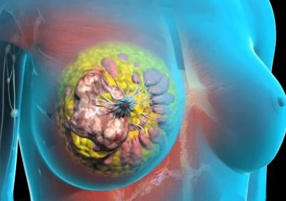 РАК НА ГЪРДАТА. ЛЕКУВА ЛИ СЕ ЗЛОКАЧЕСТВЕН РАК НА ГЪРДАТА?