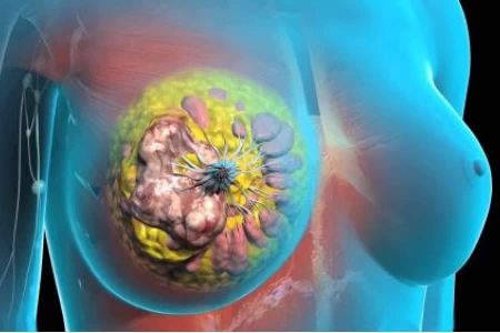 РАК НА ГЪРДАТА. ЛЕКУВА ЛИ СЕ ЗЛОКАЧЕСТВЕН РАК НА ГЪРДАТА?