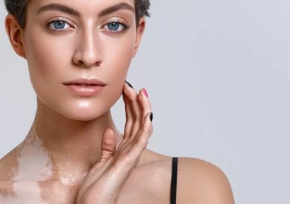 ВИТИЛИГО ЛЕЧЕНИЕ. ВИТИЛИГО ПРИЧИНИ. ВИТИЛИГО СИМПТОМИ