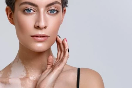 ВИТИЛИГО ЛЕЧЕНИЕ. ВИТИЛИГО ПРИЧИНИ. ВИТИЛИГО СИМПТОМИ