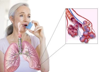 БРОНХИАЛНА АСТМА | АСТМА ПРИ ДЕЦАТА | КАРДИАЛНА АСТМА