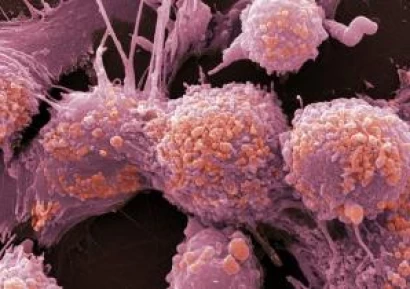 ИЗЛЕКУВАНИ ОТ РАК С МЕТСТАЗИ|ТЕРАПИЯ ГЕРСОН|НАРОДНИ СРЕДСТВА