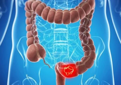РАК НА ДЕБЕЛОТО ЧЕРВО СИМПТОМИ |КРЪВНИ ИЗСЛЕДВАНИЯ |ЛЕЧЕНИЕ
