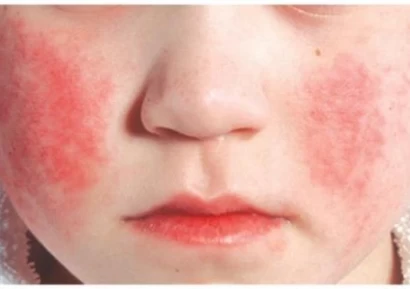 ПЕТА БОЛЕСТ | БУМ ПРИ ДЕЦАТА | ПРИЧИНИ И СИМПТОМИ | ЛЕЧЕНИЕ