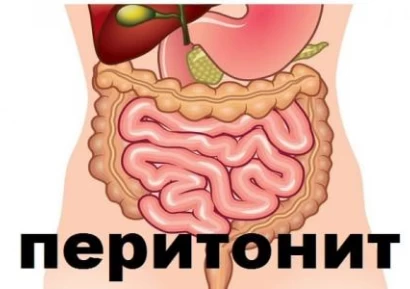 ПЕРИТОНИТ СИМПТОМИ | СМЪРТНОСТ ПРИ ПЕРИТОНИТ | ДИЕТА