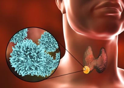 РАК НА ЩИТОВИДНАТА ЖЛЕЗА |КОЛКО СЕ ЖИВЕЕ |ЛЕКАРСТВА И БИЛКИ