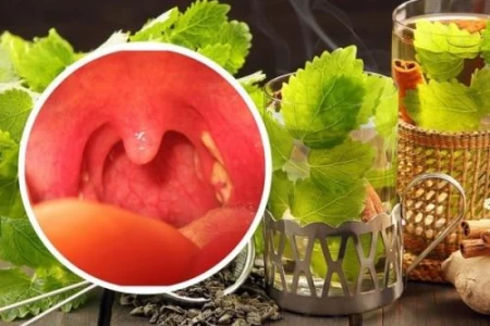 ГНОЙНА АНГИНА ДОМАШНО ЛЕЧЕНИЕ | РЕЦЕПТИ ЗА ВЪЗПАЛЕНО ГЪРЛО