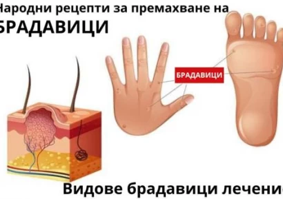 ВИДОВЕ БРАДАВИЦИ | ГЕНИТАЛНИ БРАДАВИЦИ | КАК СЕ ПРЕМАХВАТ