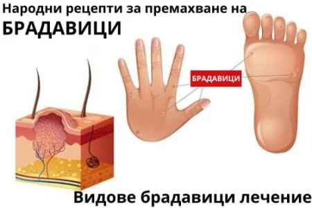 ВИДОВЕ БРАДАВИЦИ | ГЕНИТАЛНИ БРАДАВИЦИ | КАК СЕ ПРЕМАХВАТ