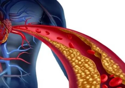 АТЕРОСКЛЕРОЗА СИМПТОМИ - АТЕРОСКЛЕРОЗА ЛЕЧЕНИЕ | БИЛКИ