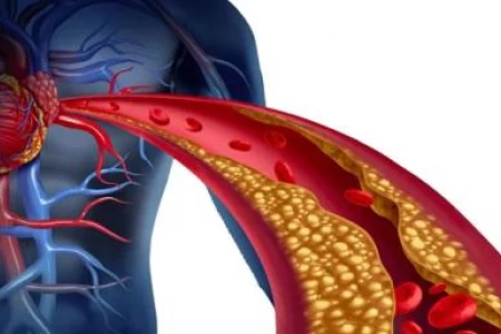 АТЕРОСКЛЕРОЗА СИМПТОМИ - АТЕРОСКЛЕРОЗА ЛЕЧЕНИЕ | БИЛКИ