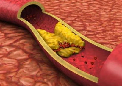 АТЕРОСКЛЕРОЗА - ОСЕМ ПРОДУКТА, КОИТО ПОМАГАТ