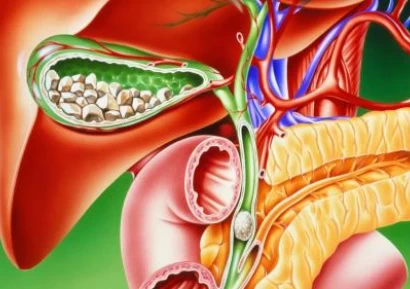КАМЪНИ В ЖЛЪЧКАТА -ПРИЧИНИ, СИМПТОМИ И ЛЕЧЕНИЕ