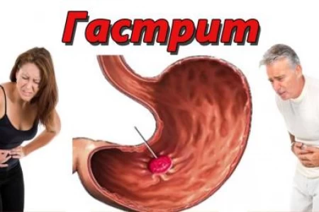 ГАСТРИТ СИМПТОМИ | КЪДЕ БОЛИ ГАСТРИТ | ХАПЧЕТА ЗА ГАСТРИТ