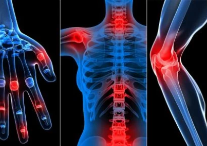 ВЪЗПАЛЕНИЕ НА СТАВИТЕ - ВИДОВЕ, ПРИЧИНИ, СИМПТОМИ И ЛЕЧЕНИЕ