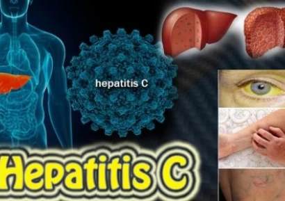 КОЛКО СЕ ЖИВЕЕ С ХЕПАТИТ С| ЗАРАЗЕН ЛИ Е ХЕПАТИТ С| ЛЕЧЕНИЕ