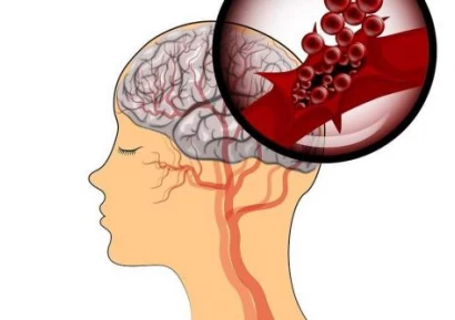 МОЗЪЧЕН КРЪВОИЗЛИВ - ПРИЧИНИ, СИМПТОМИ И КАК СЕ ЛЕКУВА