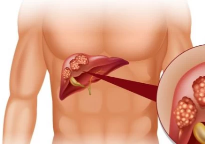 КОЛКО СЕ ЖИВЕЕ С РАК НА ЧЕРНИЯ ДРОБ | ЕТАПИ И ЛЕЧЕНИЕ