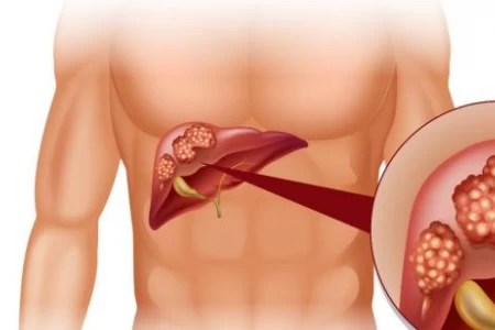 КОЛКО СЕ ЖИВЕЕ С РАК НА ЧЕРНИЯ ДРОБ | ЕТАПИ И ЛЕЧЕНИЕ