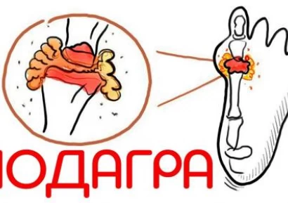 ПОДАГРА - КАКВО ДА ПРАВИМ ПРИ ВИСОКА ПИКОЧНА КИСЕЛИНА?