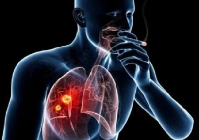 РАК НА БЕЛИЯ ДРОБ СИМПТОМИ. СТАДИИ, ЛЕКАРСТВА, ХИМИОТЕРАПИЯ