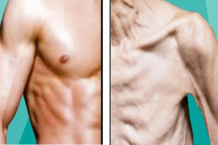 МУСКУЛНА ДИСТРОФИЯ ЛЕЧЕНИЕ | СИМПТОМИ И ВИДОВЕ