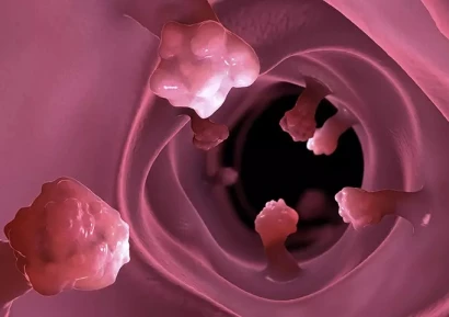 КАК ДА РАЗБЕРЕМ, ЧЕ ИМАМЕ ПОЛИПИ НА ДЕБЕЛОТО ЧЕРВО