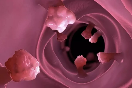 КАК ДА РАЗБЕРЕМ, ЧЕ ИМАМЕ ПОЛИПИ НА ДЕБЕЛОТО ЧЕРВО