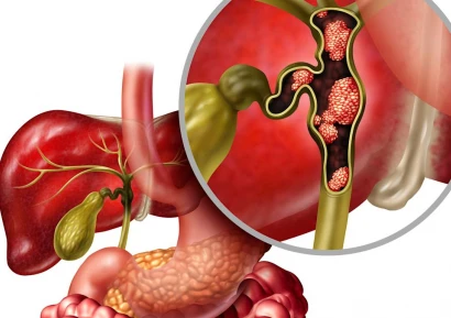 РАННИ СИМПТОМИ ЗА РАК НА ЖЛЪЧНИТЕ ПЪТИЩА