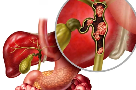 РАННИ СИМПТОМИ ЗА РАК НА ЖЛЪЧНИТЕ ПЪТИЩА