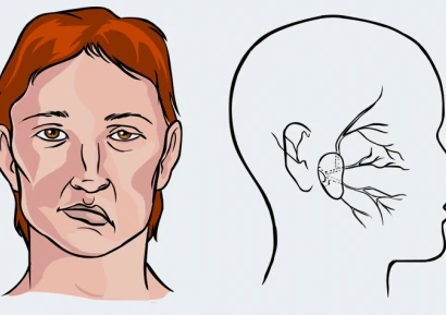 МИКРОИНСУЛТ СИМПТОМИ | ЛЕКАРСТВА ПРИ МИКРОИНСУЛТ