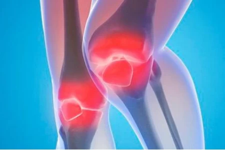 ГОНАРТРОЗА ЛЕЧЕНИЕ | ХРАНЕНЕ ПРИ ГОНАРТРОЗА | БИЛКИ