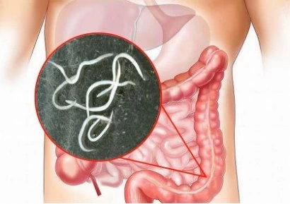 ПАРАЗИТИ В ЧЕРВАТА | КАК СЕ ЛЕКУВАТ | ДИЕТА И БИЛКИ