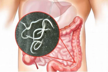 ПАРАЗИТИ В ЧЕРВАТА | КАК СЕ ЛЕКУВАТ | ДИЕТА И БИЛКИ