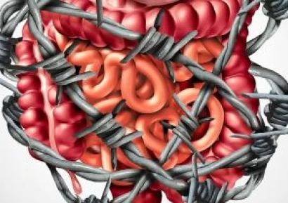 СИНДРОМ НА РАЗДРАЗНЕНОТО ЧЕРВО | СИМПТОМИ, ЛЕЧЕНИЕ, ДИЕТА