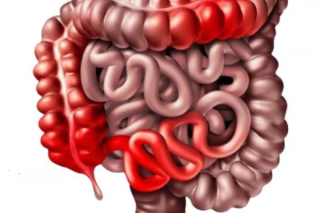 БОЛЕСТ НА КРОН | СИМПТОМИ, ДИЕТА, ЛЕКАРСТВА И БИЛКИ