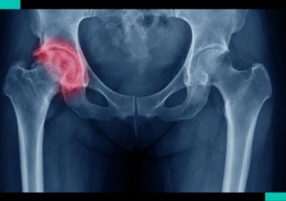 НАЙ-ДОБРОТО ЛЕКАРСТВО ЗА КОКСАРТРОЗА